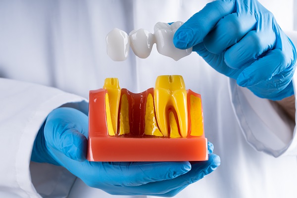 Caring For Your Dental Bridge: Tips For Longevity