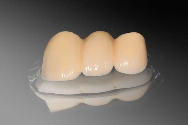 Benefits Of Dental Bridges