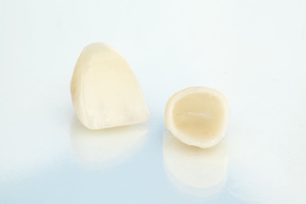 Dental Crowns, Onlays, Or Inlays: Which Is Best For You?