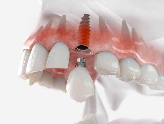 Dental Implant Stevensville, MT