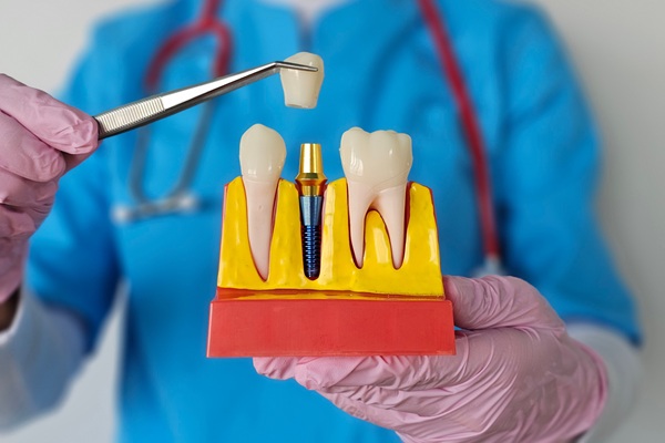 What To Do If A Dental Implant Crown Breaks