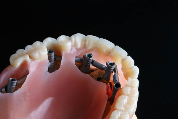 Implant Supported Dentures Stevensville, MT