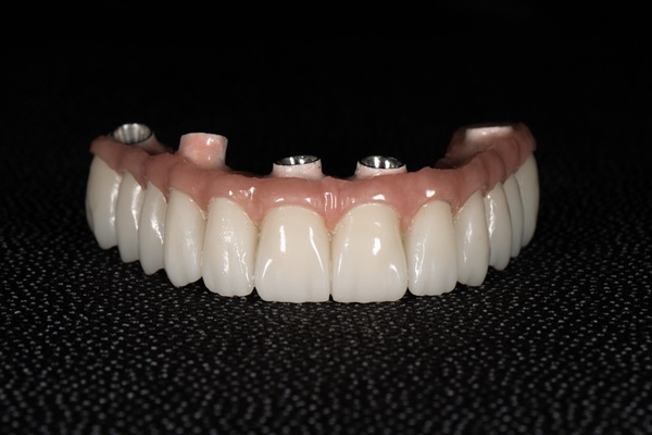 Are Implant Supported Dentures Possible With A Single Procedure?